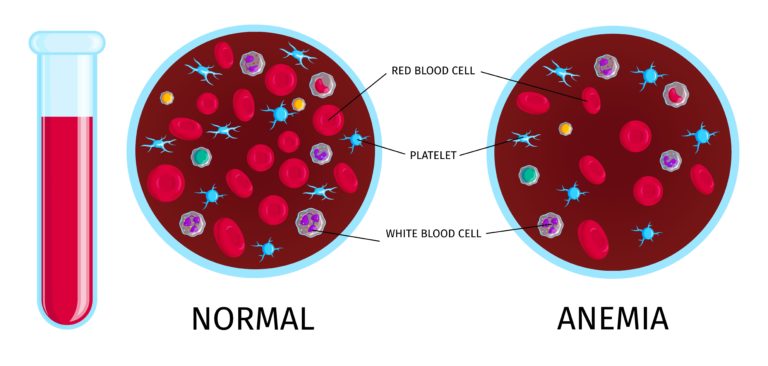 فقر الدم أو الأنيميا